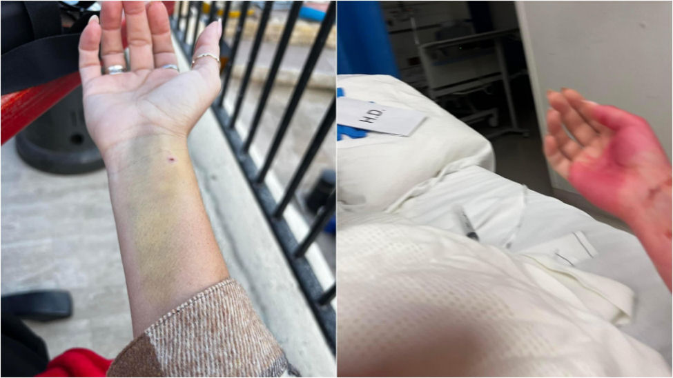 Florencia Tarque's wrist following her angiogram procedure. Tarque describes the process as painful, having been awake throughout.