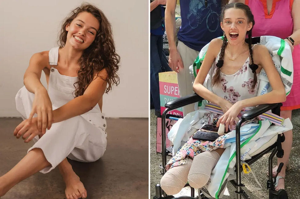 21 year old fully vaccinated model Claire Bridges lost both legs from Covid complications